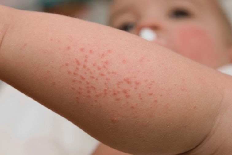 osip na koži kod beba