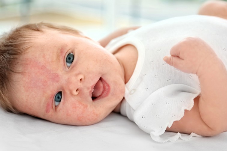 atopijski dermatitis slike